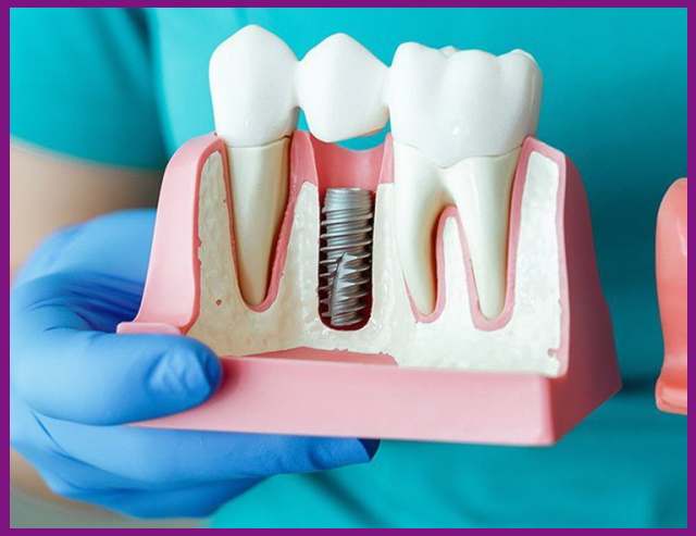 trồng răng implant là giải pháp phục hình răng cửa tốt nhất hiện nay