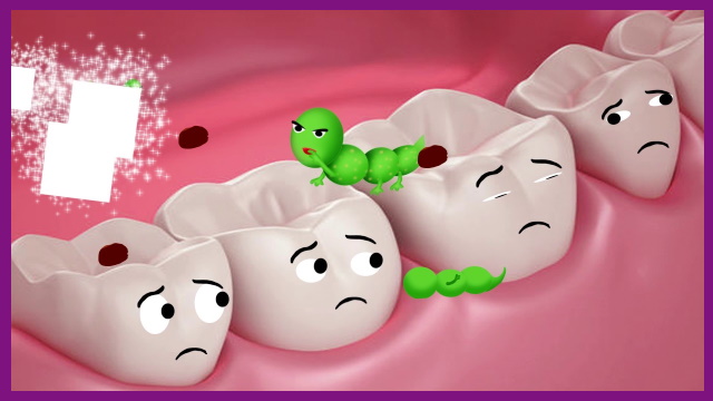 viêm tủy chân răng là do vi khuẩn xâm nhập vào tủy răng gây ra