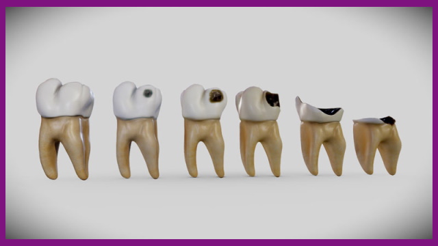 sâu răng là nguyên nhân chính khiến tủy răng bị tổn thương