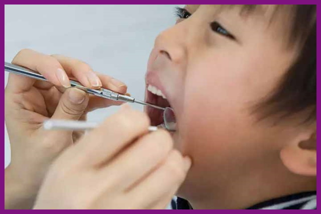 viêm tủy răng ở trẻ em cần được chữa trị kịp thời để bảo tồn được răng thật