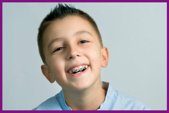 lứa tuổi của trẻ rất dễ niềng răng chỉnh nha nếu có tình trạng răng lệch lạc, hô món xảy ra