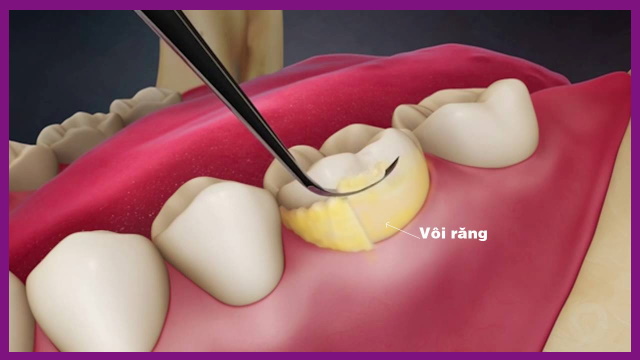điều trị viêm nha chu bằng cạo vôi răng để lấy đi mảng bám trên răng