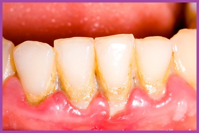 cao răng là hậu quả viêm nha chu