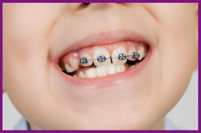 niềng răng cho trẻ cần được thực hiện bởi một nha khoa uy tín