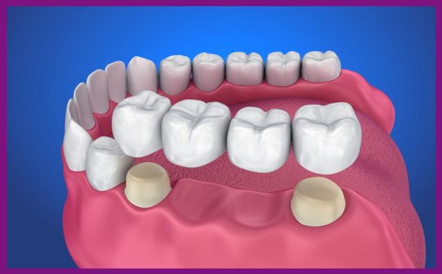 cầu răng sứ là cần phải mài hai răng kế cận để làm cầu bắc răng giả
