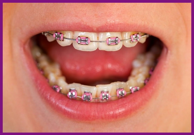 sau niềng răng, trẻ sẽ có một hàm răng đều tăm tắp, đúng chuẩn thẩm mỹ