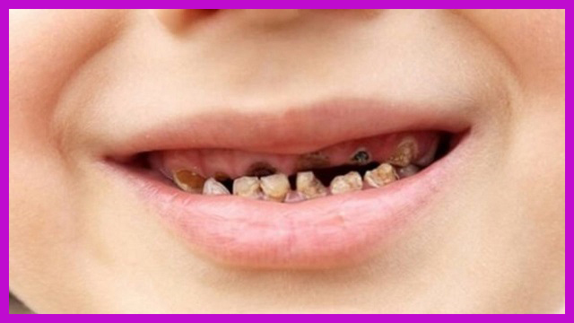 dấu hiệu mọc răng hàm ở trẻ là gì