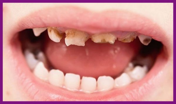 Dấu hiệu răng bị mòn ở trẻ em
