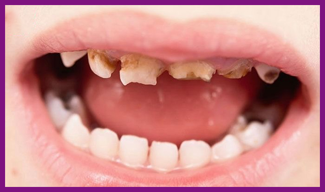Dấu hiệu răng bị mòn ở trẻ em