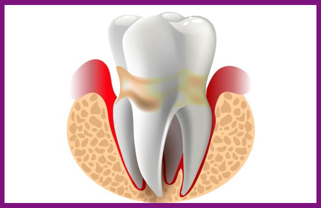 răng bị bệnh nha chu sẽ có hiện tượng tụt nướu