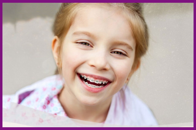 niềng răng, chỉnh nha tại phòng khám sẽ giúp nắn chỉnh răng bé về đúng vị trí như ban đầu