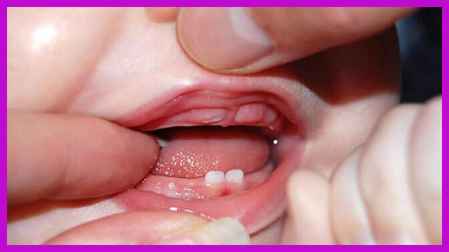 điều trị trẻ 3 tháng mọc răng sớm