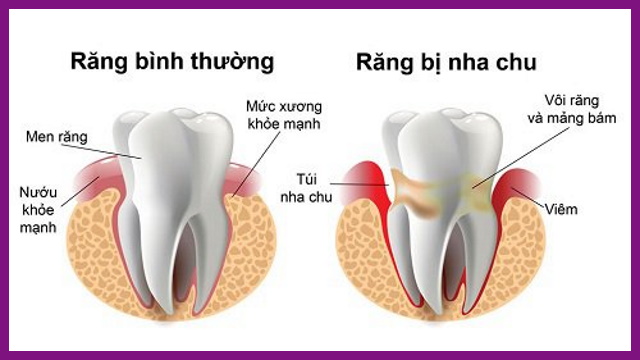 biểu hiện của bệnh nha chu tới thời kỳ mãn tính là tụt lợi, răng dần lung lay khỏi nướu