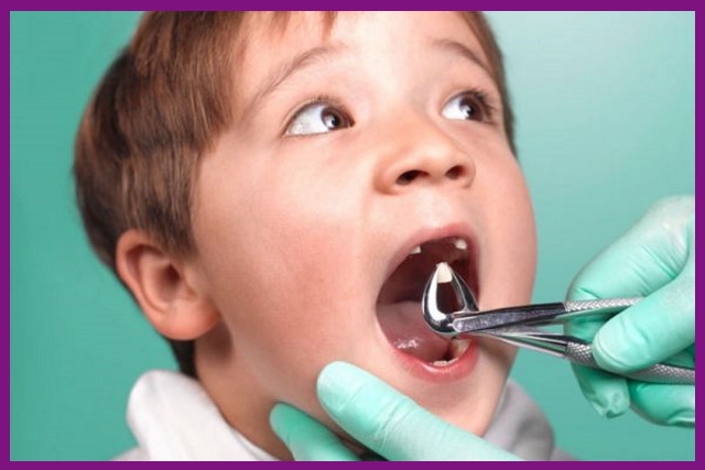 trong trường hợp em bé bị sâu răng nặng thì nhất thiết phải nhổ răng để cho răng mới mọc lên