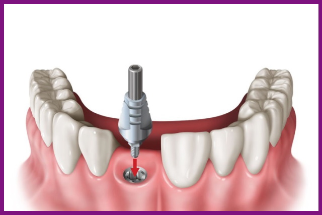 trồng răng implant là phương pháp phục hình răng cố định được ưa chuộng nhất hiện nay