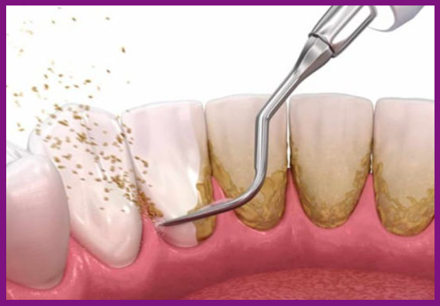 lấy vôi răng sẽ giúp ngăn ngừa được bệnh nha chu tiến triển nặng