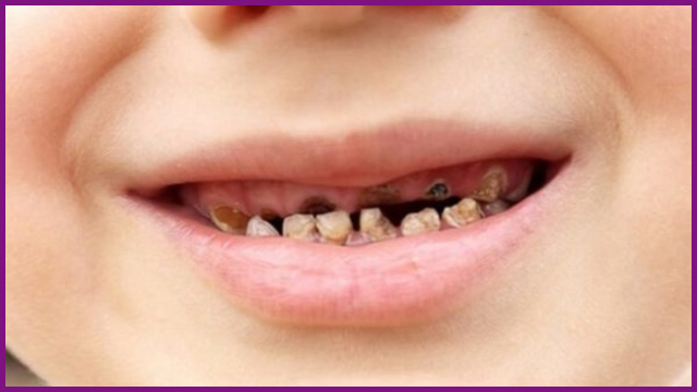 Tổng hợp hình ảnh răng sâu trẻ em bố mẹ cần đặc biệt lưu ý