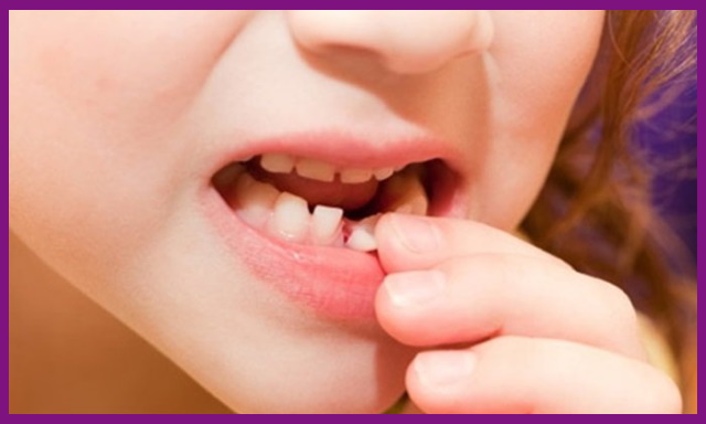 đưa trẻ đi khám sẽ hạn chế được nguy cơ mất răng sữa sớm ở trẻ nhỏ