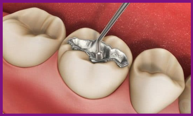 nếu răng sâu ăn vào tủy thì cần phải trám để không khiến tình trạng răng sâu nặng hơn