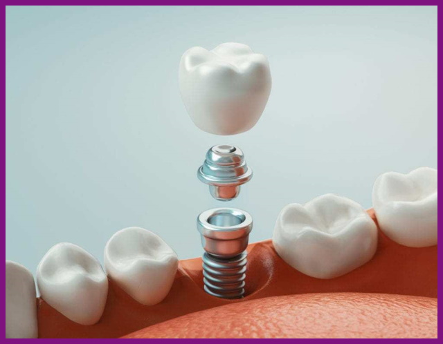 trụ implant đóng vai trò như chân răng thật