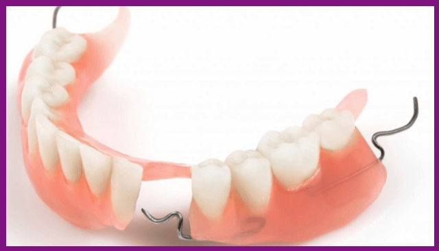 hàm khung có các móc nối cài vào răng thật giúp nâng đỡ vững chắc cho hàm giả hơn dước tác động của lực ăn nhai