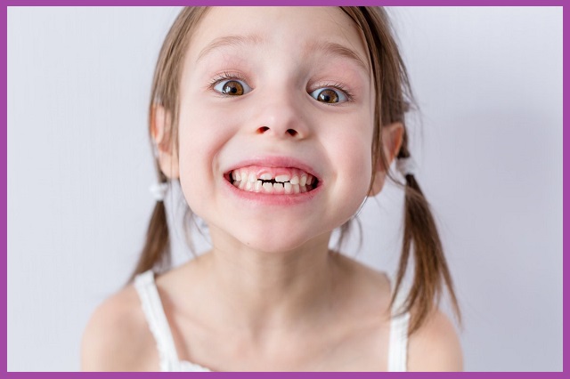 nắn chỉnh răng cho trẻ em bằng hàm trainer