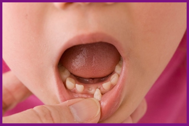 khi đến độ tuổi thay răng, răng sữa của bé sẽ có hiện tượng lung lay và và rụng đi nhanh chóng