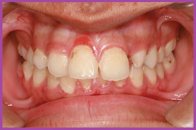 nhổ răng khôn hàm dưới tại tphcm