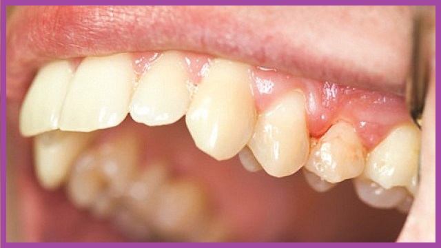 nhổ răng số 7 không bị hóp má tại tphcm