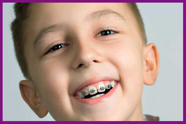  răng cho trẻ 13 tuổi có được không