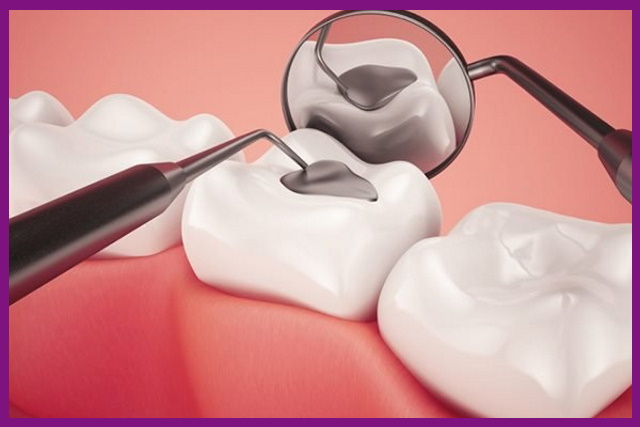 trám răng sẽ giúp bảo vệ răng trẻ không bị sâu nặng hơn