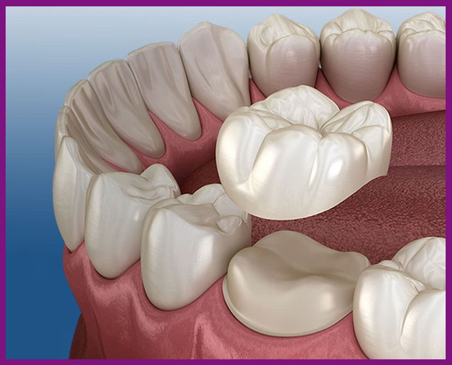 phục hình răng cố định là giải pháp phục hình răng thẩm mỹ hiện đại nhất hiện nay