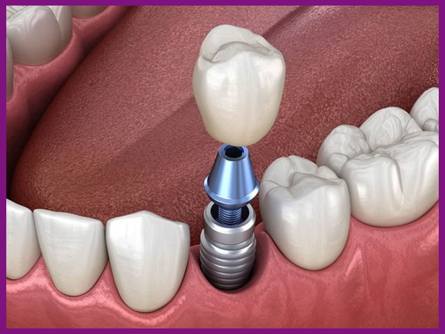 cấu tạo răng sứ implant giống với răng thật