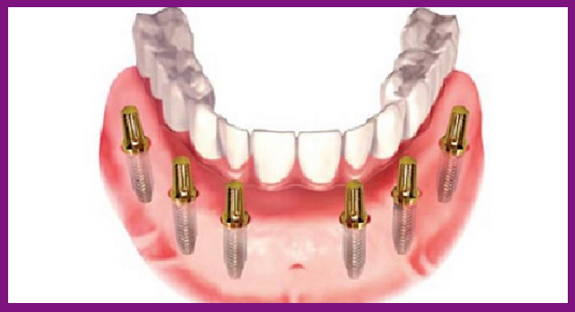 all on 6 là phương pháp phục hình răng tháo lắp cho người bị mất răng hoàn toàn