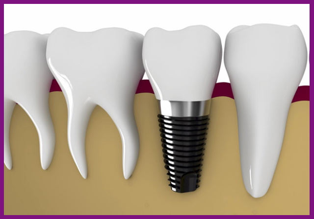 trồng răng implant là giải pháp phục hình răng hiện đại nhất hiện nay