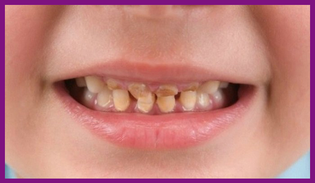Răng bị mòn ở trẻ em phải làm sao