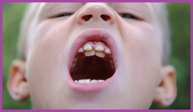 tác hại của bé mọc 1 răng