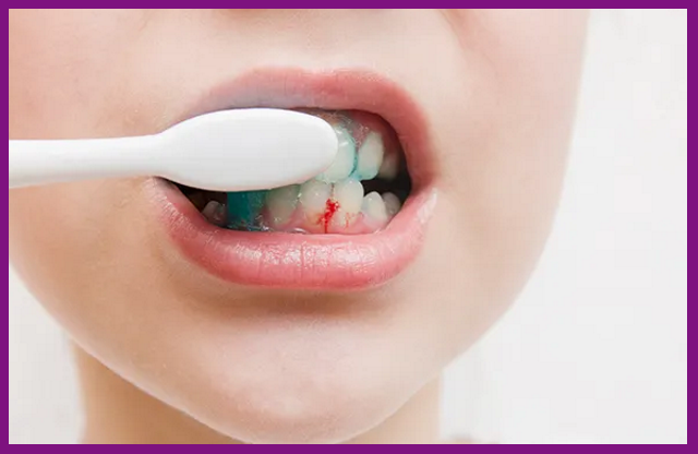 khi bị viêm nha chu sẽ thấy hiện tượng chảy máu chân răng khi chải răng