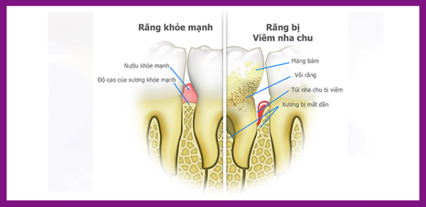 cấu trúc răng bị viêm