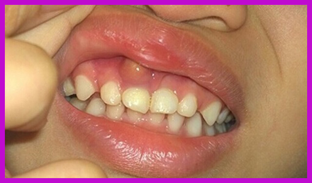 trẻ bị viêm lợi khi mọc răng tphcm