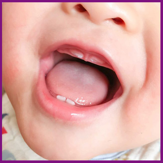 Trẻ con mọc răng như thế nào