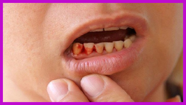 trẻ em bị sưng nướu răng tphcm