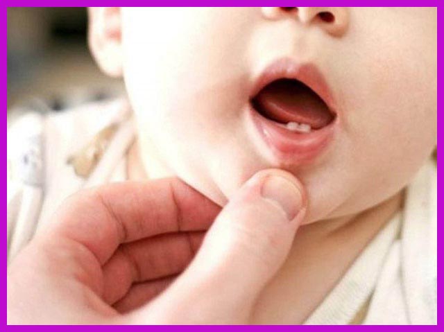 trẻ sơ sinh mọc răng điều trị sao