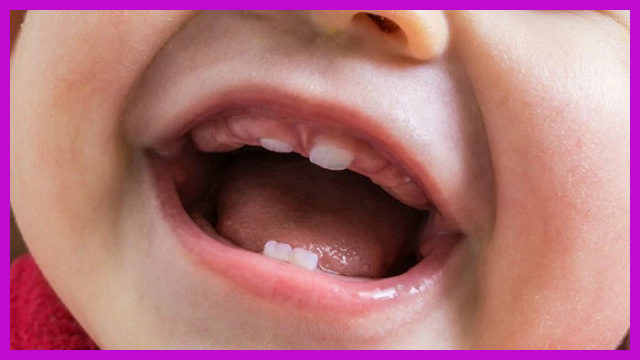 trẻ sơ sinh mọc răng hàm trên trước có sao không