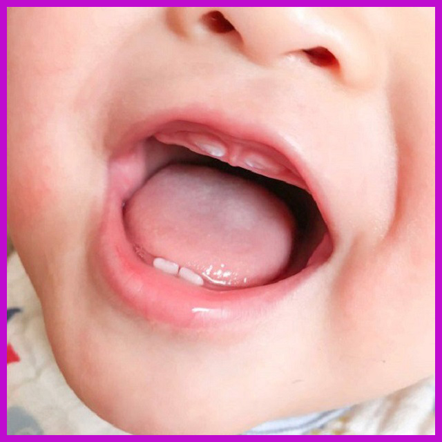 trẻ sơ sinh mọc răng hàm trên trước
