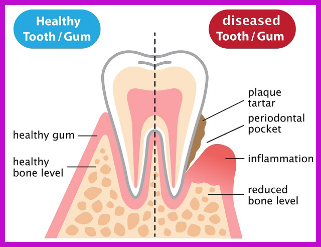 viêm nha chu tụt lợi có sao không