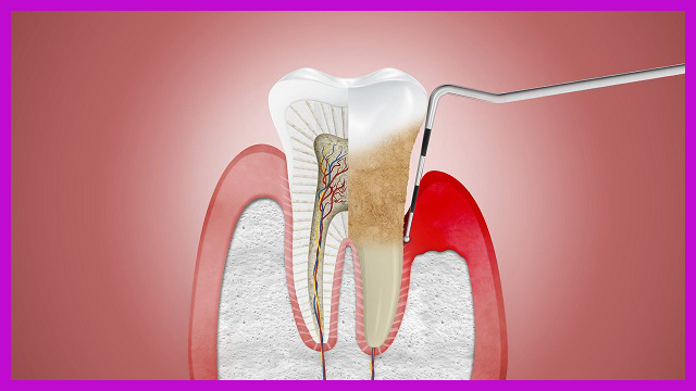 viêm nha chu tụt lợi