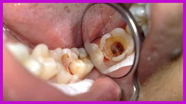 bệnh nha chu răng