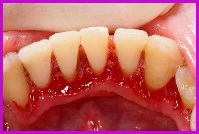 bệnh nha chu răng có nguy hiểm không