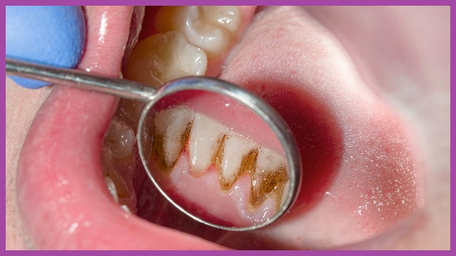 biểu hiện bệnh nha chu cao răng
